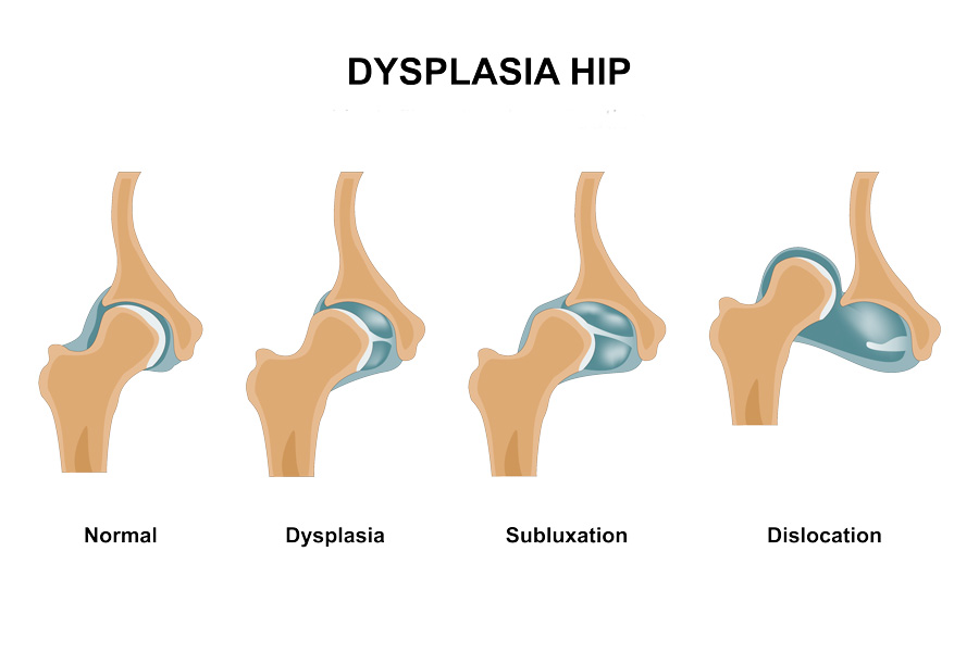 Tipos y grados de displasia de cadera