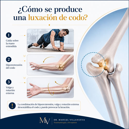 Cómo se produce una luxación de codo