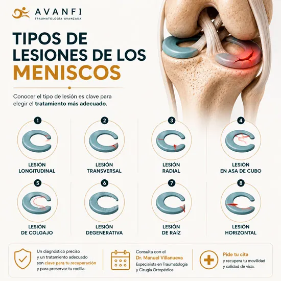 Tipos de lesiones de los meniscos de la rodilla. Cada una requiere un tipo de tratamiento personalizado