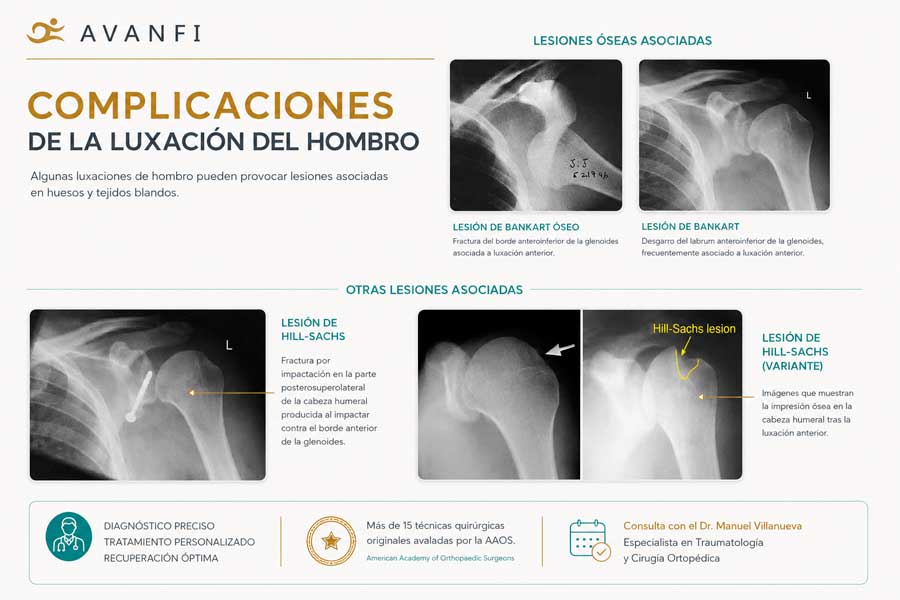 complicaciones de la luxación de hombro