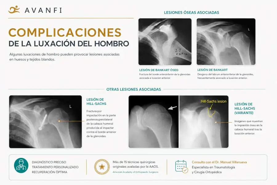 complicaciones de la luxación de hombro