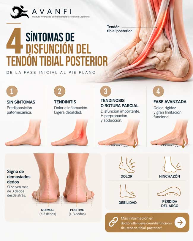 Disfunción del tendón tibial posterior