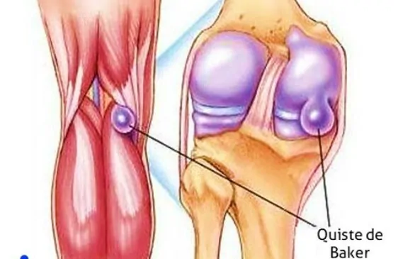 Quiste de Baker o quiste popliteo de la rodilla anatomía