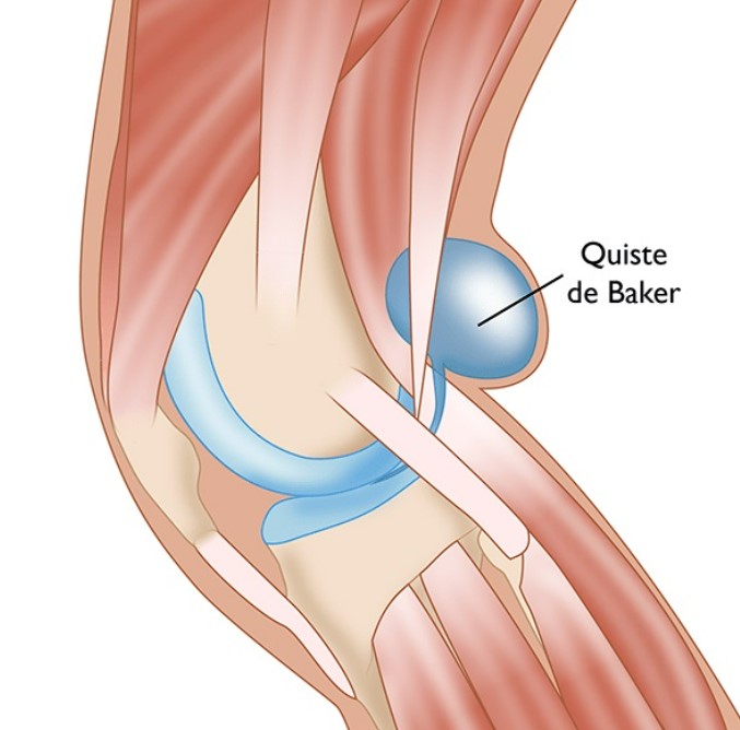 Quiste de Baker o quiste popliteo de la rodilla