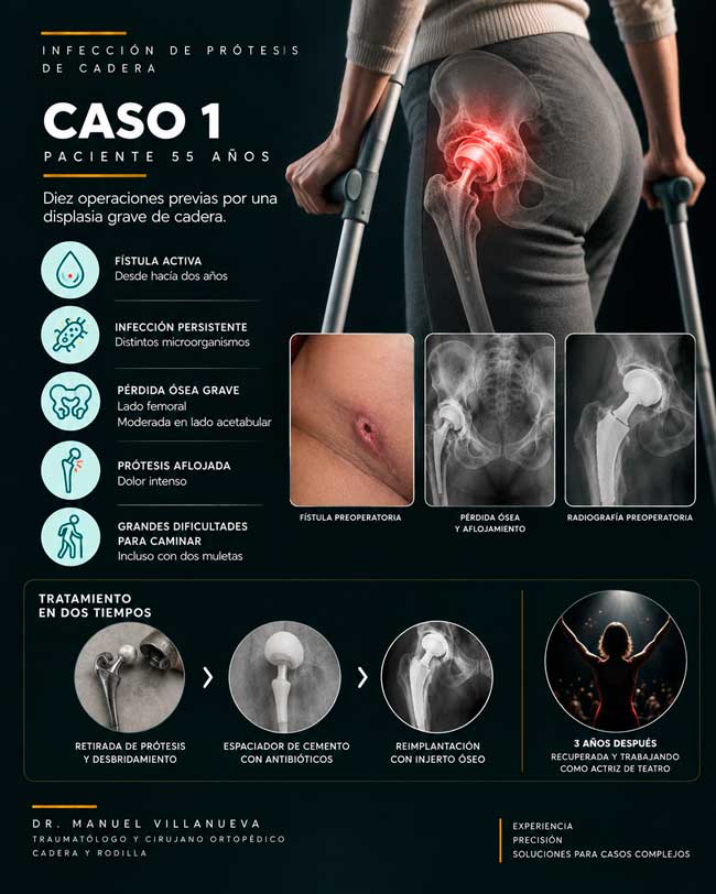 Caso clínico de infección de prótesis de cadera hecho en dos cirugías