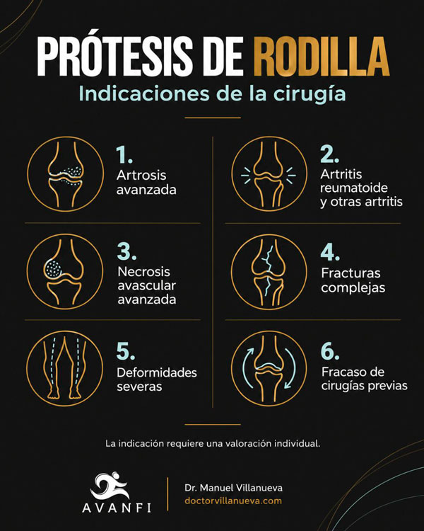 Indicaciones de la cirugía de prótesis de rodilla según el Dr. Manuel Villanueva, especialista en casos complejos de cirugía ortopédica de rodilla