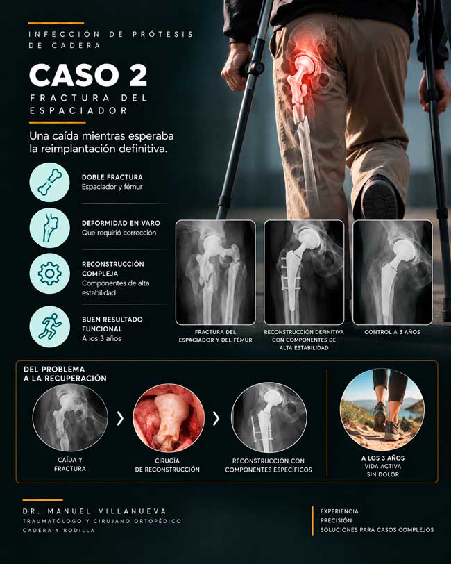 Infección de prótesis_ reconstrucción de cadera Reconstrucción de la prótesis de cadera en dos cirugías por infección previa de la prótesis. Caso clínico del Dr. Villanueva